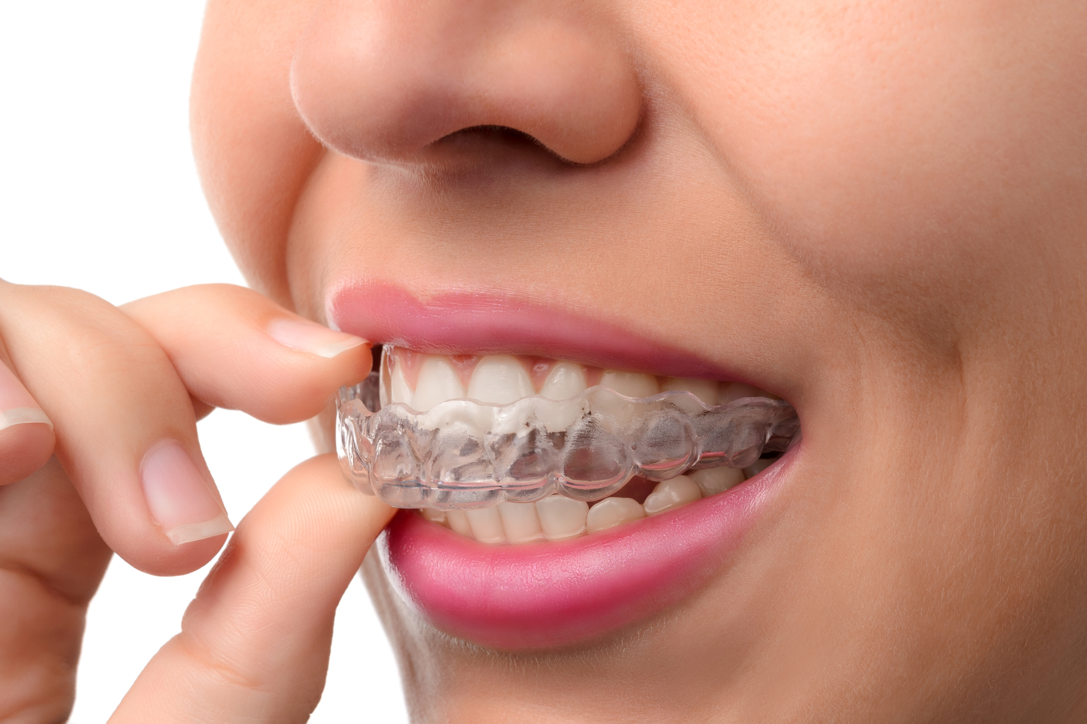Woman smiling, putting in Invisalign clear aligners