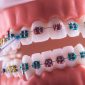 Dental model of teeth multi-colored braces.