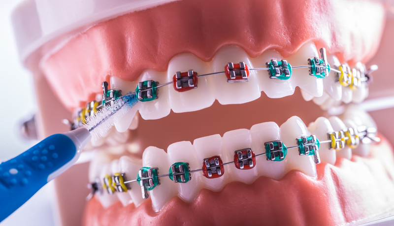 Dental model of teeth multi-colored braces.