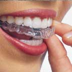 Person putting on Invisalign clear aligner