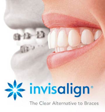 invisalign clear braces